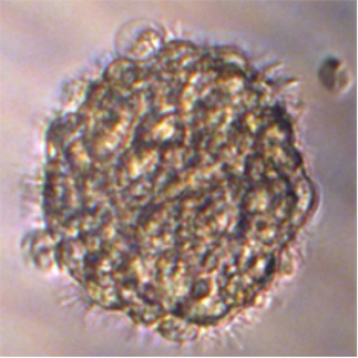 cellule tumorale