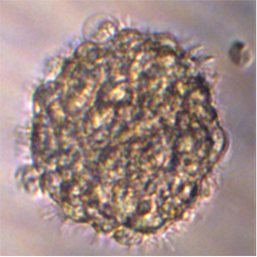cellule tumorale